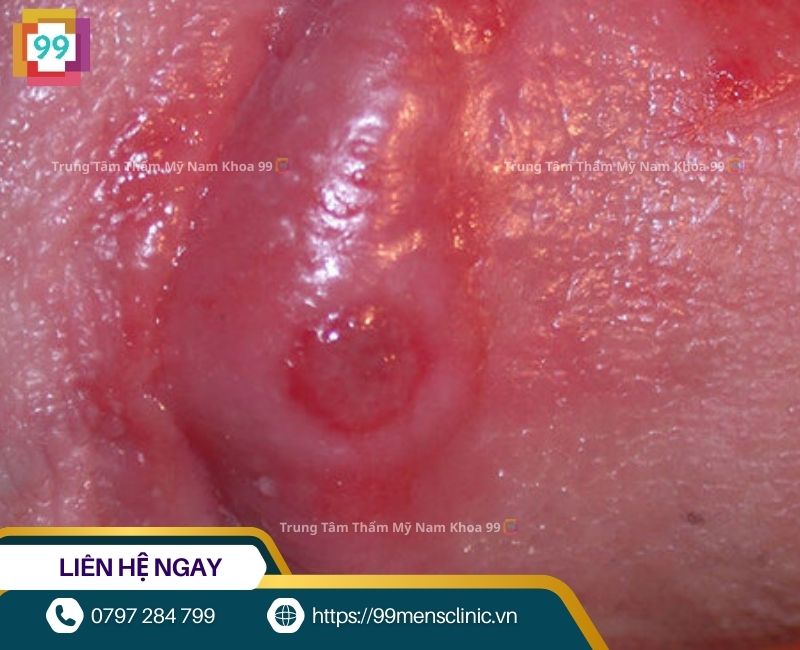 Viêm bao quy đầu gây đau đớn và có thể cản trở quan hệ tình dục