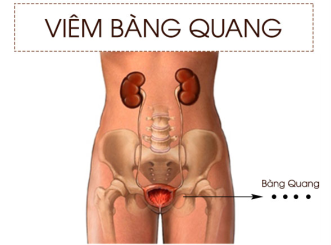 Nguyên nhân và dấu hiệu viêm bàng quang mà bạn cần nắm được 1