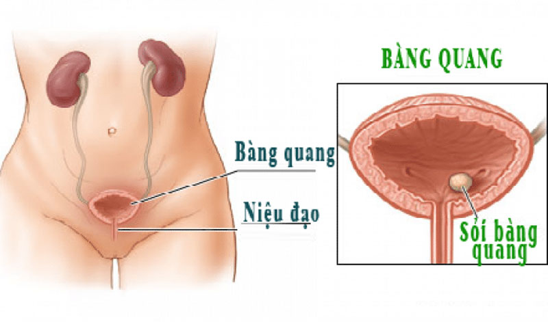 Nguyên nhân và dấu hiệu viêm bàng quang mà bạn cần nắm được 2
