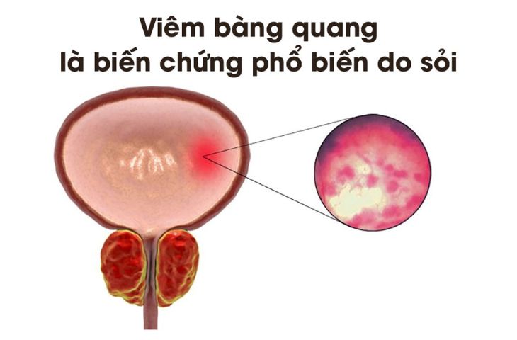 Nguyên nhân và dấu hiệu viêm bàng quang mà bạn cần nắm được 3