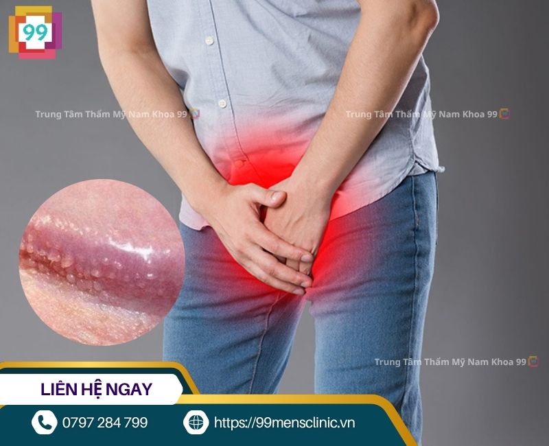 Chuỗi hạt ngọc dương vật
