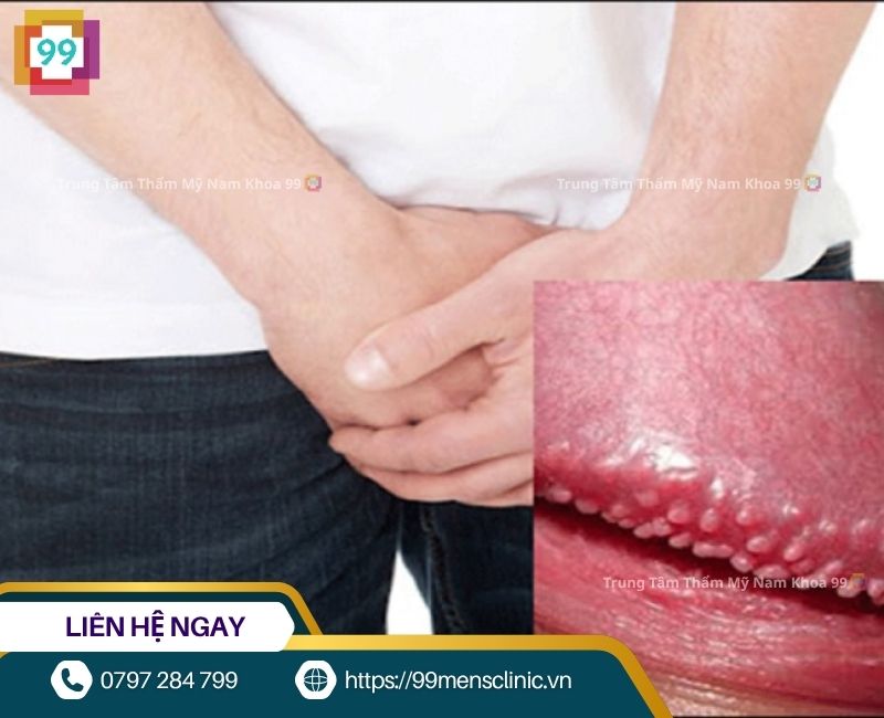 Dấu hiệu nhận biết chuỗi hạt ngọc dương vật