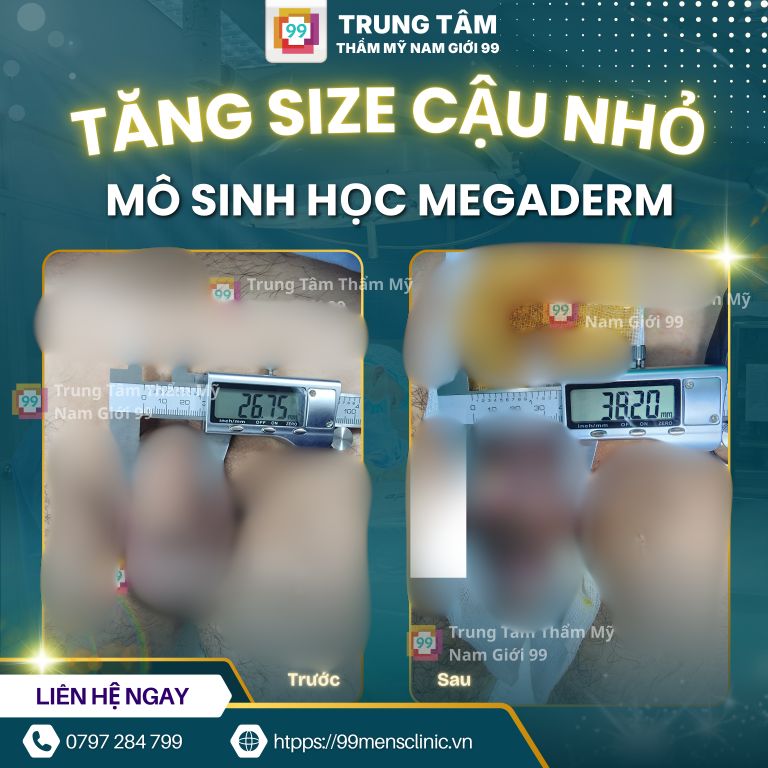 Kết quả nâng size cậu nhỏ