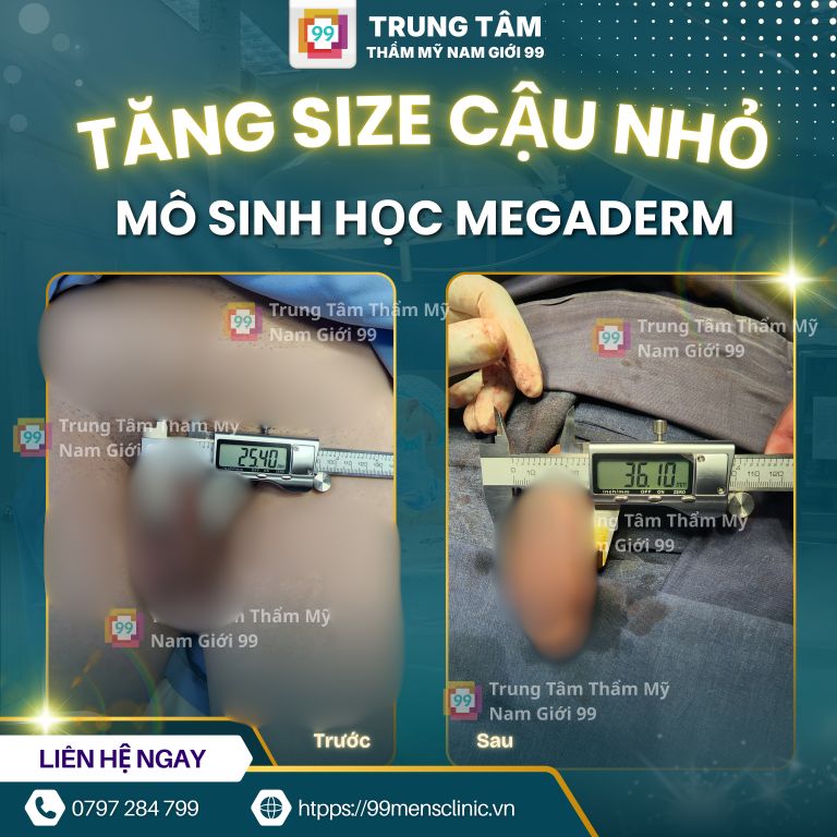 Nâng size cậu nhỏ bằng Megaderm