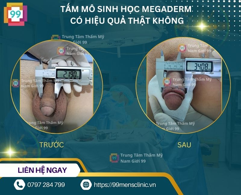 tấm mô sinh học megaderm có hiệu quả thật không