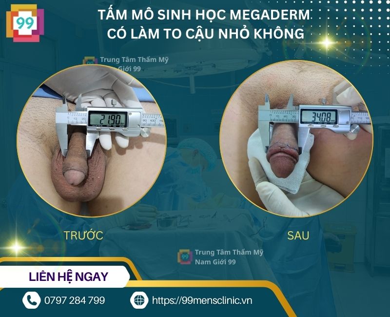 Tấm mô sinh học megaderm có làm to dương vật không