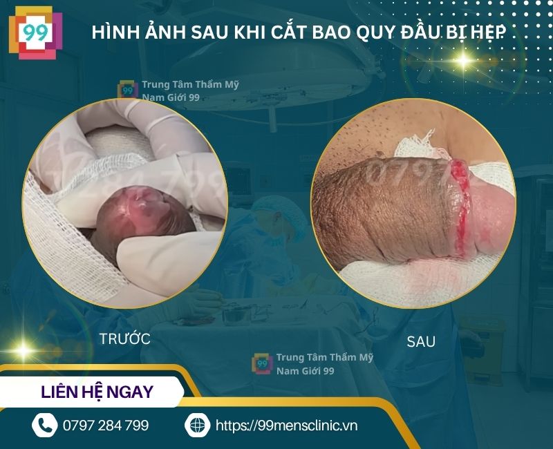 Hình ảnh sau khi cắt bao quy đầu bị hẹp