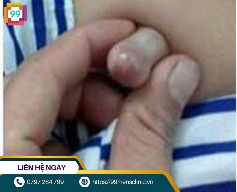 Hình ảnh viêm bao quy đầu ở trẻ nhỏ bị biến chứng