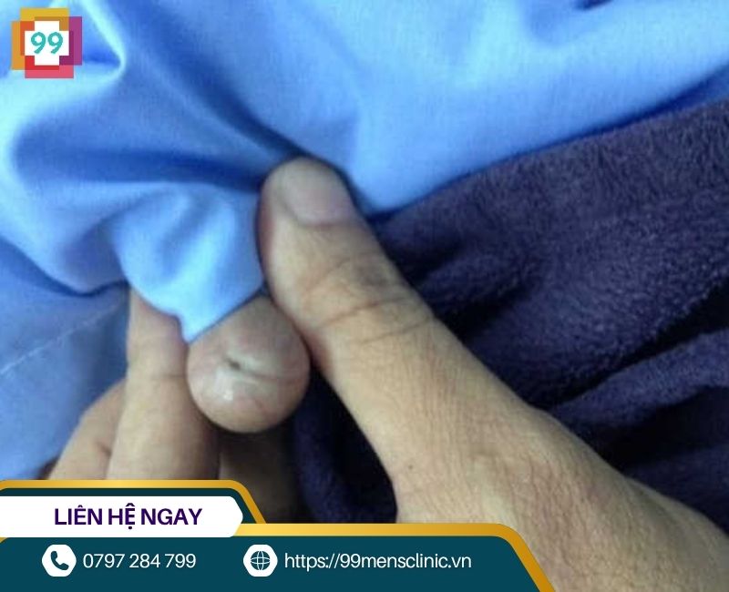 Hình ảnh viêm bao quy đầu ở trẻ nhỏ giai đoạn nặng