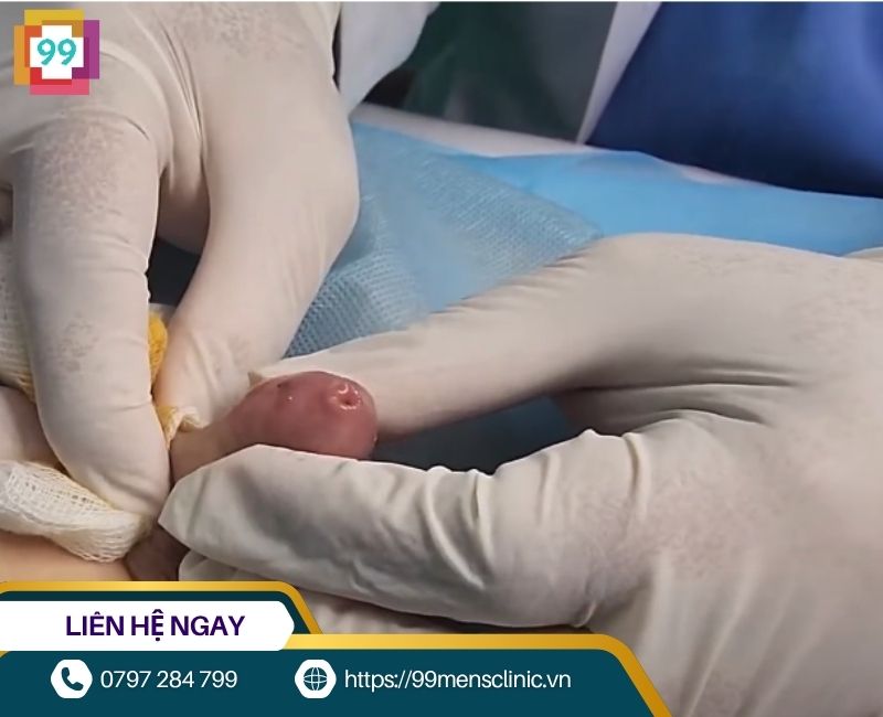 Hình ảnh viêm bao quy đầu ở trẻ nhỏ giai đoạn nhẹ