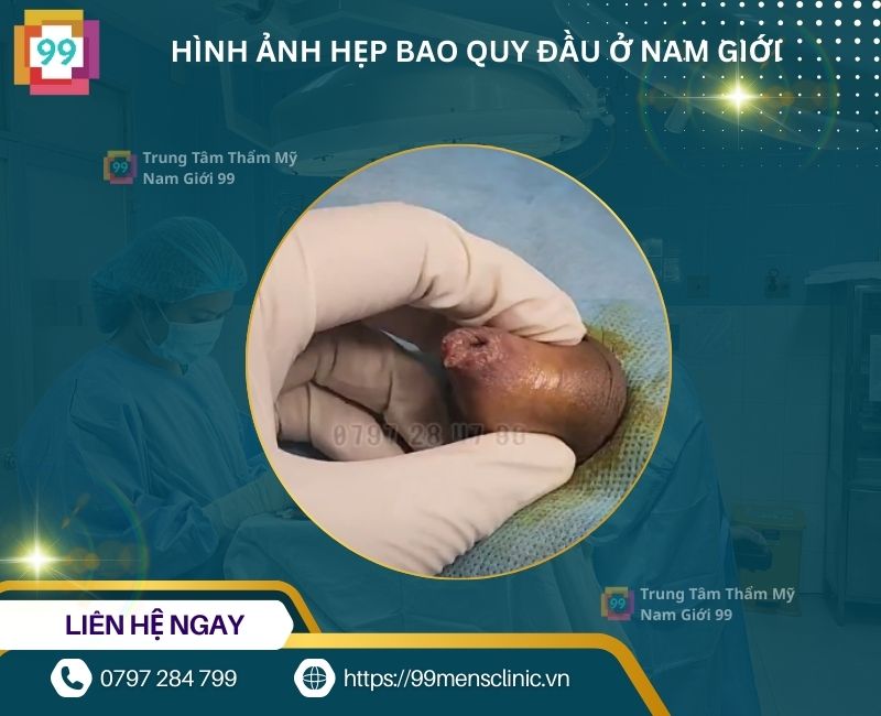 Hẹp bao quy đầu ở nam giới dẫn đến viêm da