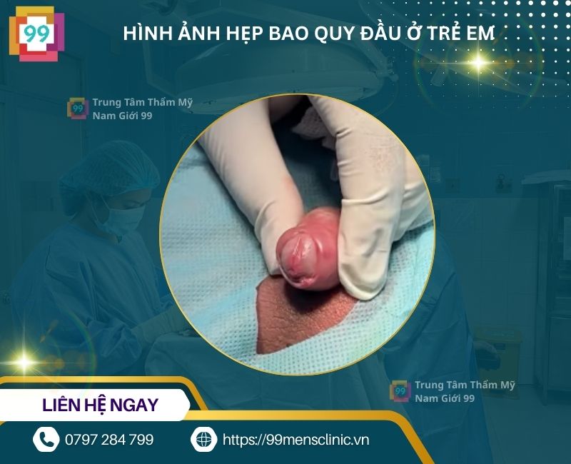 Hẹp bao quy đầu ở trẻ dẫn đến thắt ngẵn quy đầu