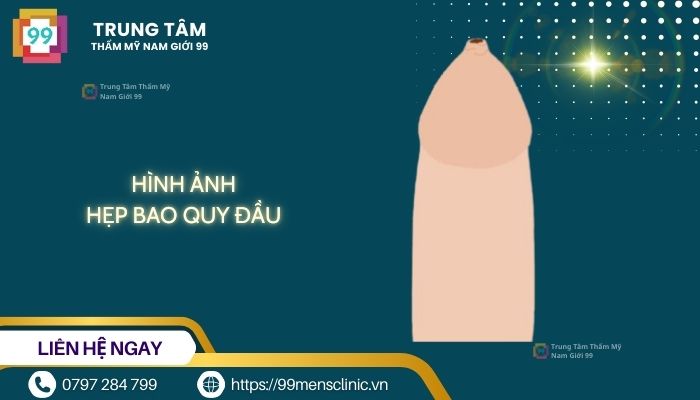 Hình ảnh hẹp bao quy đầu