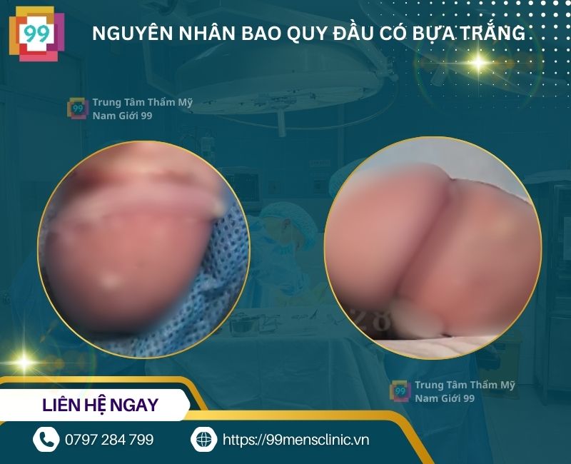 Nguyên nhân bao quy đầu có bựa trắng