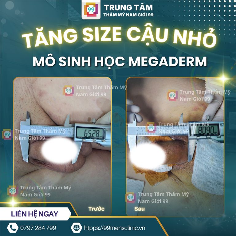 Kết quả nâng size cậu nhỏ bằng megaderm
