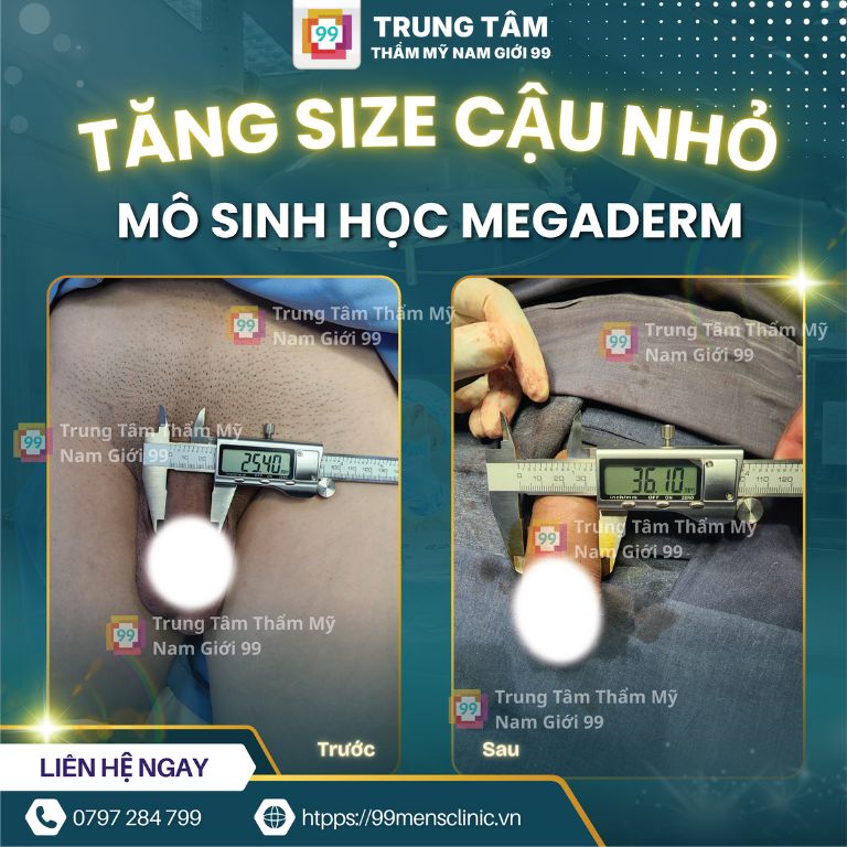Nâng size cậu nhỏ bằng Megaderm