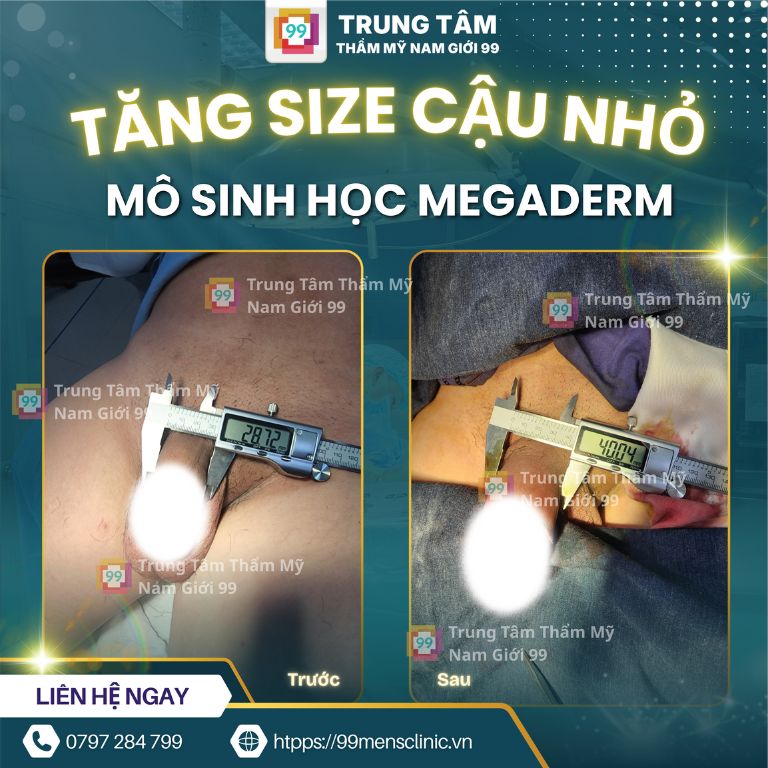 Tăng kích thước bằng megaderm